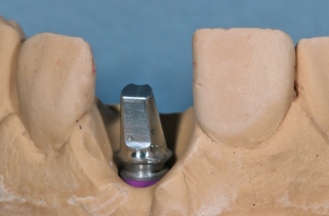 Abb. 17: Da die palatinale Lage des Implantats im Schnittbild deutlich erkennbar ist, fiel die Entscheidung für ein anguliertes Titanabutment anstelle einer klassischen Klebebasis. Das Abutment sollte dann mit dem Zirkoniumdioxidaufbau verklebt werden.