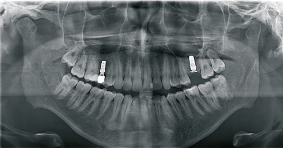 Abb. 19: Postoperatives Orthopantomogramm.