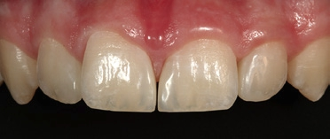 Abb. 22: Endergebnis der Behandlung in En-face-Ansicht eine Woche nach der Behandlung.