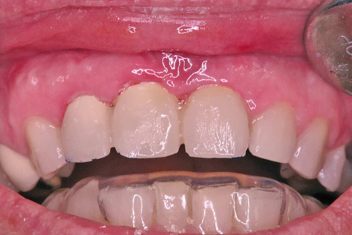 Abb. 20: Nochmalige Durchtrennung des Lippenbändchens mit Diodenlaser.