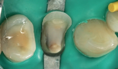 Abb. 19: Isolierung des Arbeitsfeldes mit Kofferdam.