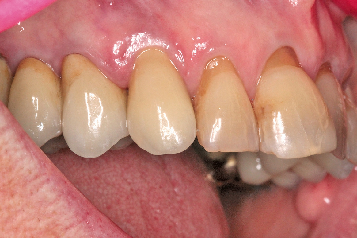 Abb. 19: … und zwei Jahre später. Optimale Papillenregeneration, insbesondere mesial.