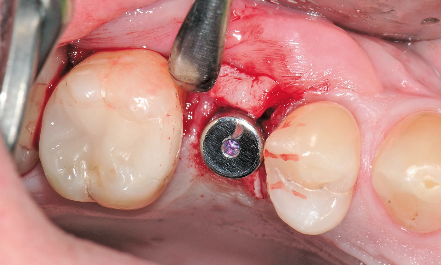 Abb. 18: Einsetzen des Gingivaformers (ohne Nahtverschluss).