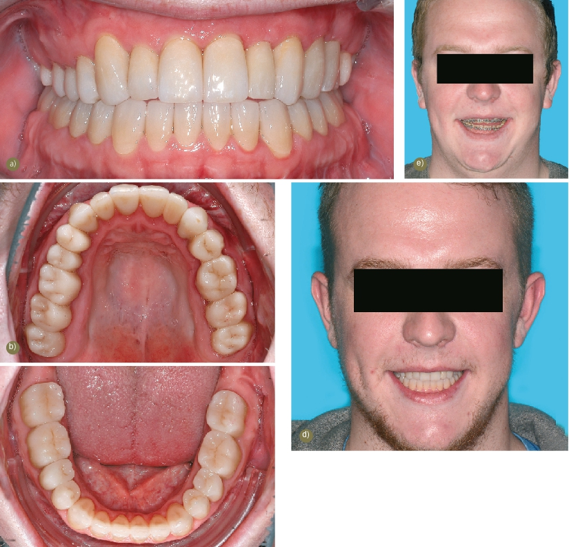 Abb. 19: Nach der defi nitiven Eingliederung der Kronen zeigte sich der Patient mit dem erreichten Ergebnis sehr zufrieden. a) Intraorale Übersicht nach der Eingliederung. b) Aufsicht Oberkiefer. c) Aufsicht Unterkiefer. d) Frontalansicht: Beim leichten Lächeln zeigt sich ein harmonischer Verlauf der Frontzähne. e) Der Erfolg zeigt sich besonders im Vergleich: Hier der Patient zu Beginn der Behandlung während der zweijährigen kieferorthopädischen Maßnahmen.