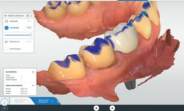 Abb. 19: Finales Design für die Krone 45 in CEREC SW 5.