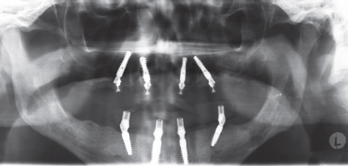 Abb. 19: OPG post-OP.