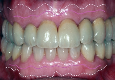 Abb. 16: Patientenbeispiel mit dickem befestigtem Gingivatyp: Die gestrichelte Linie zeigt den Übergang von keratinisierter zu unbefestigter Gingiva. Die rosa Linie zeigt die idealisierte paramarginale Schnittführung im Frontzahngebiet mit jeweils mindestens 2 mm Abstand von Inzision und Zahnfleischsaum bzw. Übergang zum unbefestigten Gingivalsaum.