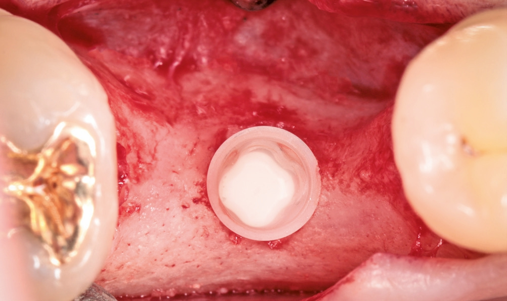 Abb. 19: Die abschließende Position des ceramic.implant von okklusal.