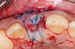 Abb. 18: Wundverschluss an der Implantationsstelle mit Nähten.