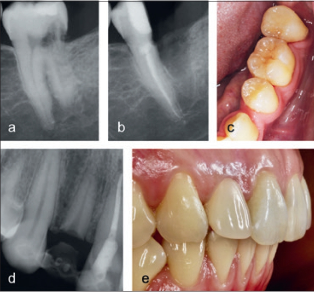 Abb. 18a-c: Hemisektion der distalen Wurzel des Zahnes 37 mit invasiver zervikaler Resorption. d u. e: Dekoronation des Zahnes 12 und Versorgung mit einer provisorischen Klebebrücke.
