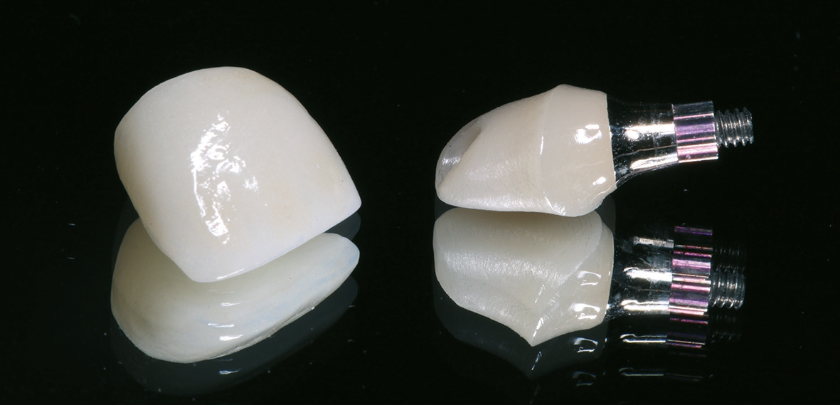 Abb. 14: Das definitive Hybrid-Abutment und die Einzelkrone zum Einsetzen.