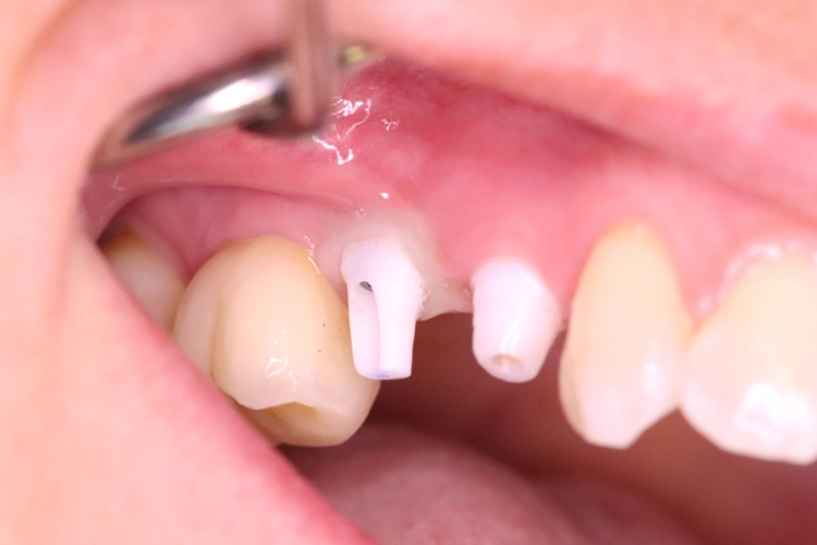 Abb. 19: Das alte Titanimplantat bekam ein neues Zirkonabutment.