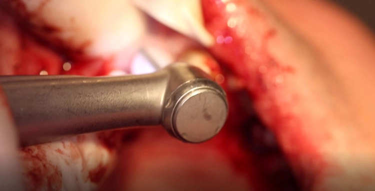 Abb. 19: Präparation der Implantate.