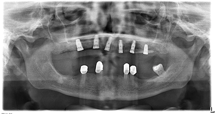 Abb. 19: OPG nach Implantation.