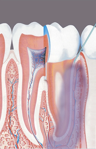 Abb. 1: Das intraligamental injizierte Anästhetikum breitet sich – eng begrenzt – entlang der Zahnwurzel und im angrenzenden Gewebe aus.