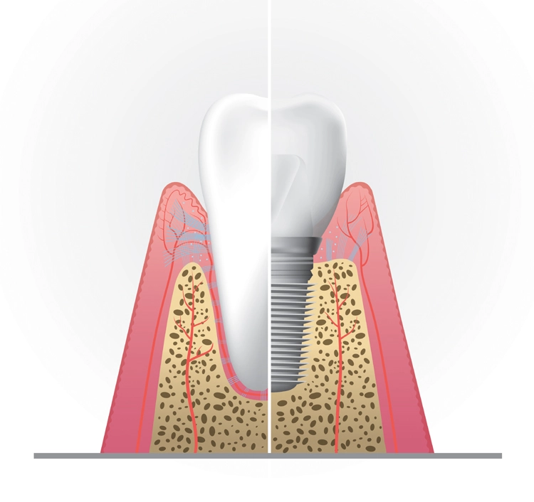 Abb. 2: Vergleichende Anatomie des parodontalen und periimplantären Gewebes.