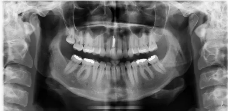 Abb. 1: Ausgangssituation zu Behandlungsbeginn mit sichtbar endodontisch behandeltem
Zahn 11.