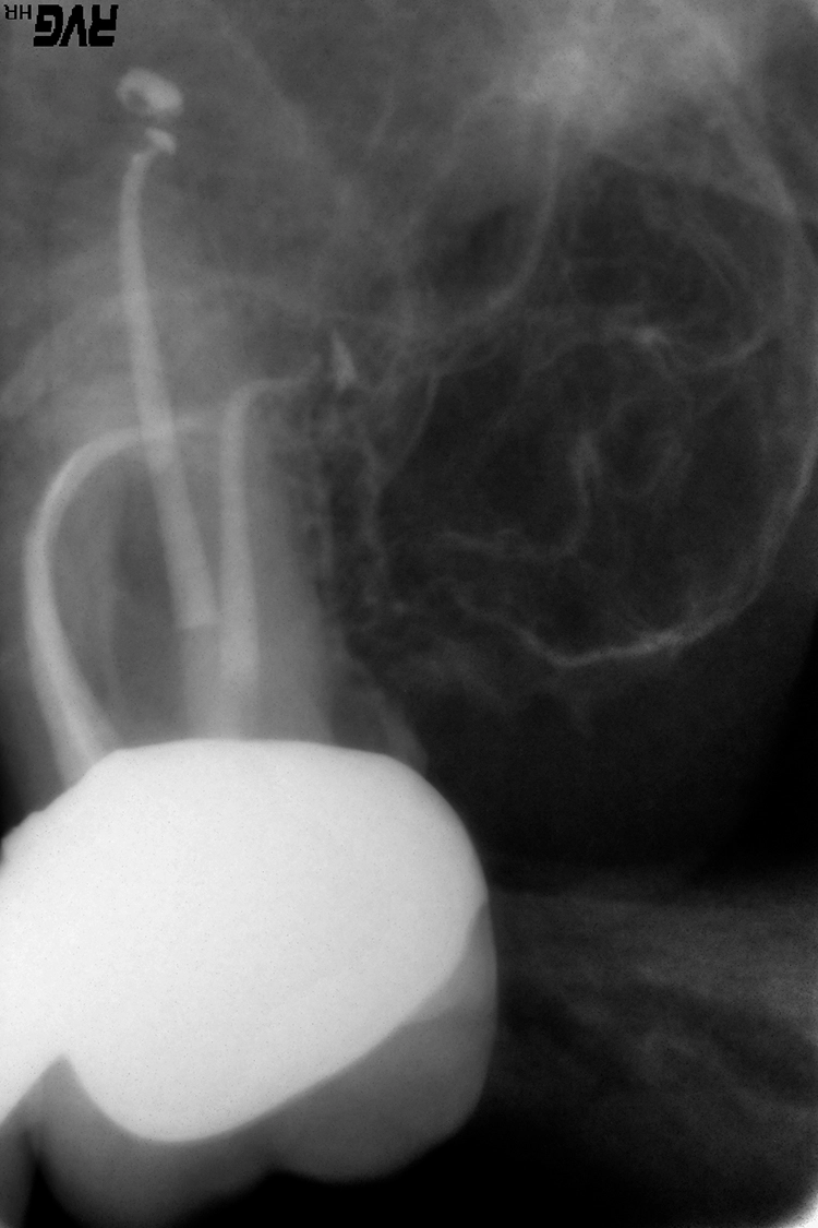 Abb. 1: Die mesiobukkale Wurzel dieses oberen
Molaren ist stärker gekrümmt als die distobukkale.
Das größere Risiko einer Instrumentenfraktur ergibt
sich aufgrund des kleineren Krümmungsradius
jedoch im distalen Wurzelkanalverlauf.