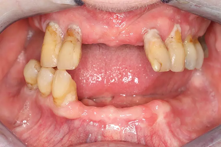 Abb. 1b: Ansicht intraoral vor Behandlungsbeginn.