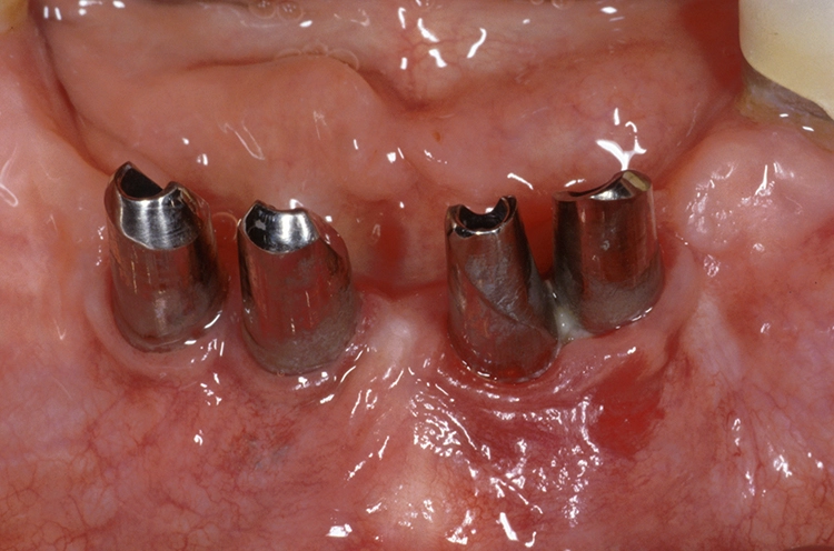 Abb. 1: Korrosion einer Titanrestauration. Die Patientin erhielt eine implantatgestützte Konuskronenarbeit. Die Innenkronen, die Außenkronen und das Gerüst wurden aus Titan gefertigt. Um die Gleiteigenschaften der Außenkronen auf den Innenkronen zu verbessern, erhielten die Außenkronen eine Innenauskleidung aus Galvanogold. Die Patientin klagte über Metallgeschmack. a: Intraorale Situation der Implantate mit Innenkronen regio 42, 41, 31 und 32. Zwischen den Implantaten regio 31 und 32 erhöhte Sondiertiefen und Pusaustritt.