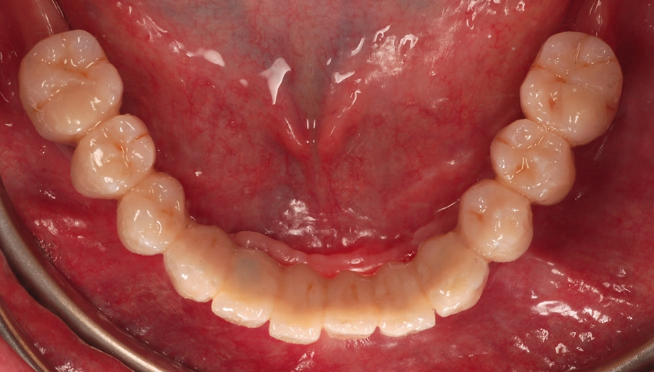 Abb. 20: Verblendbrücke in situ mit mittels Komposit verschlossenen Schraubenkanälen.