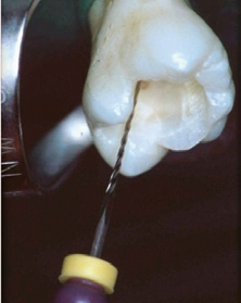 Abb. 11a: Das Instrument kann initial häufig nur aus distaler Richtung in den mb2 eingebracht werden und stößt bereits nach 3–4 mm gegen eine Dentinwand.