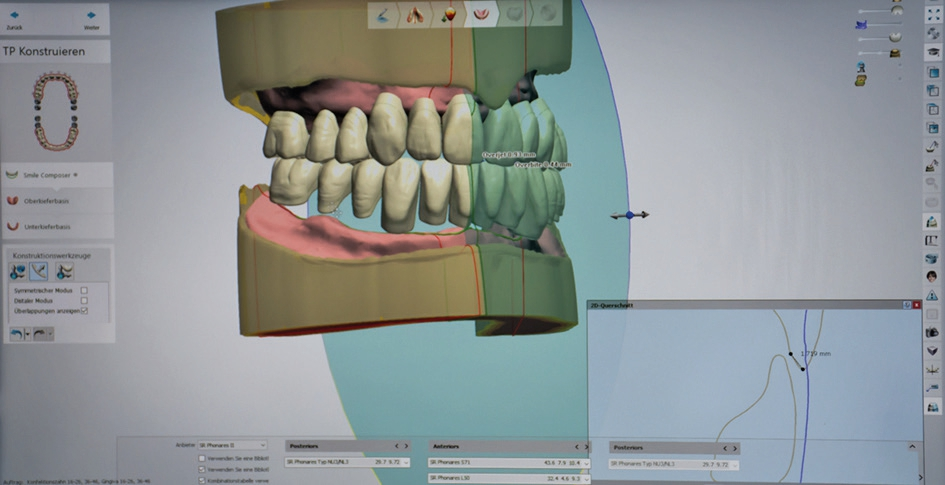 Abb. 20: Anpassung von Overjet und Overbite.