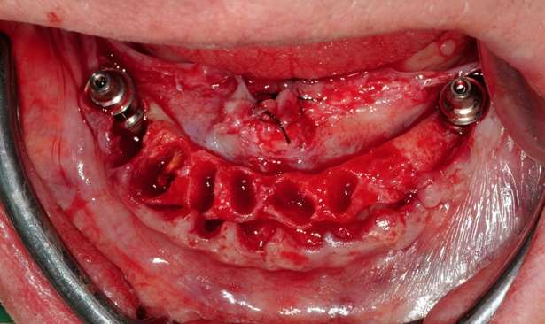 Abb. 20: Inserierte Implantate mit Abutmens, die 35° kompensieren.