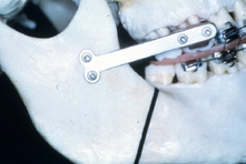 Abb. 18: Plattenpositionierung vor der sagittalen Spaltung zur intraoperativen Reproduktion der zentralen Kondylenposition.