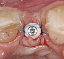 Abb. 20: Das Weichgewebe wurde mit 6-0 Prolene dicht um den Gingivaformer vernäht.