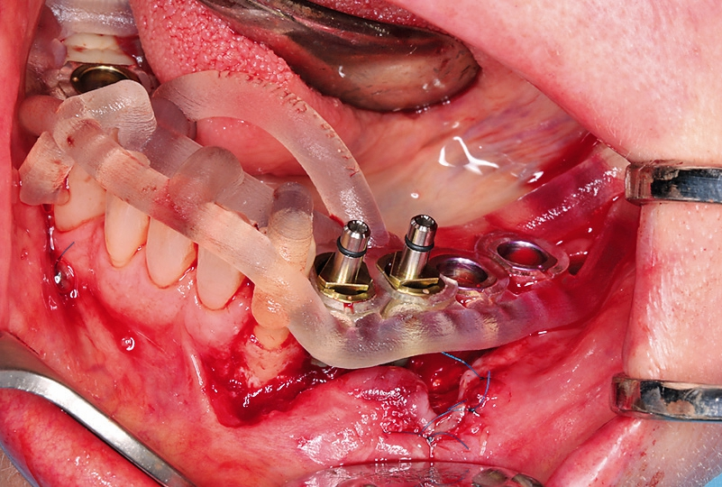 Abb. 20: Insertion der vier Implantate.