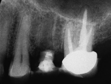 Abb. 20: Röntgenologisch ist die knöcherne Durchbauung der Alveole nachweisbar. Die Lamina dura ist noch abgrenzbar. Insbesondere im Bereich des interdentalen Limbus alveo-laris ist eine Zunahme des knöchernen Angebotes zu erkennen.