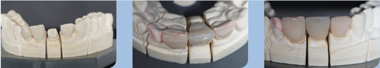 Abb. 28–30: Meistermodell für die finale Versorgung mit Keramikkrone und Veneers.