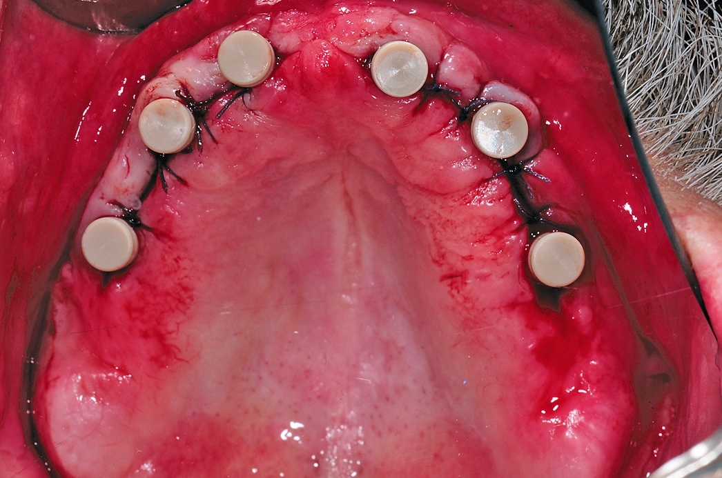 Abb. 18: Gingivaformer nach Freilegung der Implantate im Oberkiefer.