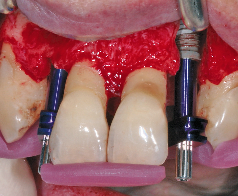 Abb. 20: Implantate eingebracht mit Abformpfosten.