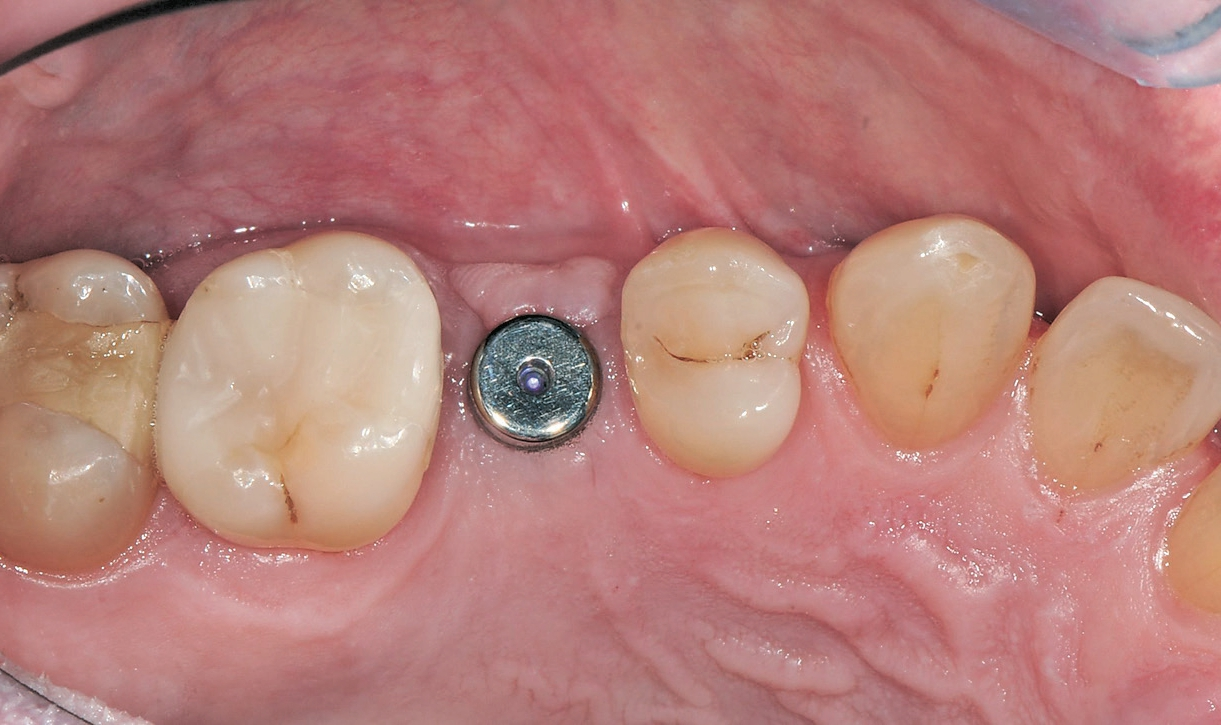 Abb. 19: Gingivaformer in situ zirka drei Wochen nach der Freilegung.