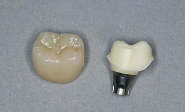 Abb. 20: CAD/CAM-gefertigtes individuelles Zirkonabutment aus inCoris meso, gesintert und mit eingeklebter Titanbasis, Krone aus CeltraDuo, bemalt und glasiert.