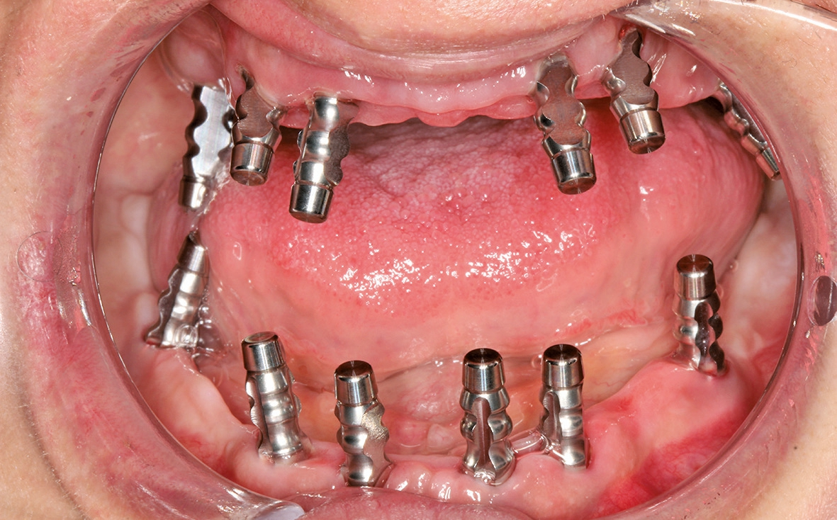 Abb. 20: Megagen Abformpfosten in situ.