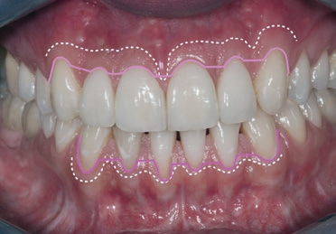 Abb. 17: Patientenbeispiel mit dünner, keratinisierter Gingiva: Die gestrichelte Linie zeigt den Übergang von keratinisierter zu unbefestigter Gingiva. Die rosa Linie zeigt die idealisierte Schnittführung mit Papillen-Basis-Schnitt im Frontzahngebiet.