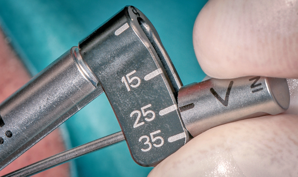 Abb. 20: Mit der Handratsche wurde abschließend die Primärstabilität geprüft.
