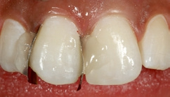 Abb. 20: Dentinmasse D1 im palatinalen Bereich des Zahnes 11.