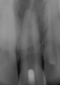 Abb. 20: Zahn 21 mit weit offenem Foramen und umfangreicher apikaler Osteolyse.