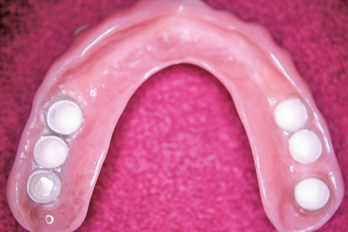 Abb. 14b: Die neue OK-Prothese von basal.