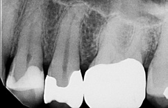 Abb. 20: Die Röntgenkontrollaufnahme zeigt die aufgrund des enthaltenen Yttrium-Fluorids sehr gute Röntgenopazität und die gute approximalzervikale Randadaptation.