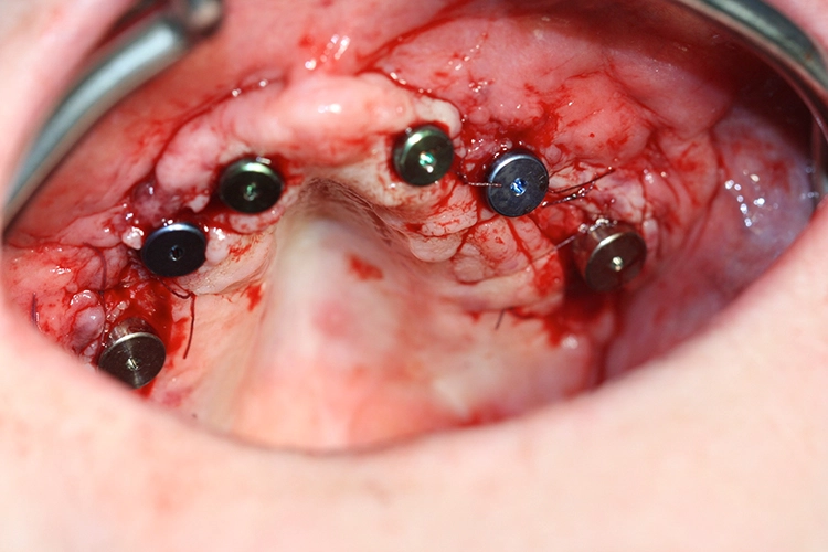 Freilegung mit Gingivaformern.