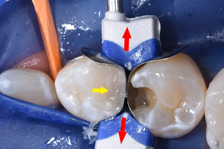Abb. 21: Zustand nach Füllen der Kavität an Zahn 34 (gelber Pfeil) mit einer Schicht Tetric PowerFill und Lichthärtung für 3 Sekunden mit der PowerCure-Lampe. Danach wird der Separierring abgenommen (rote Pfeile).