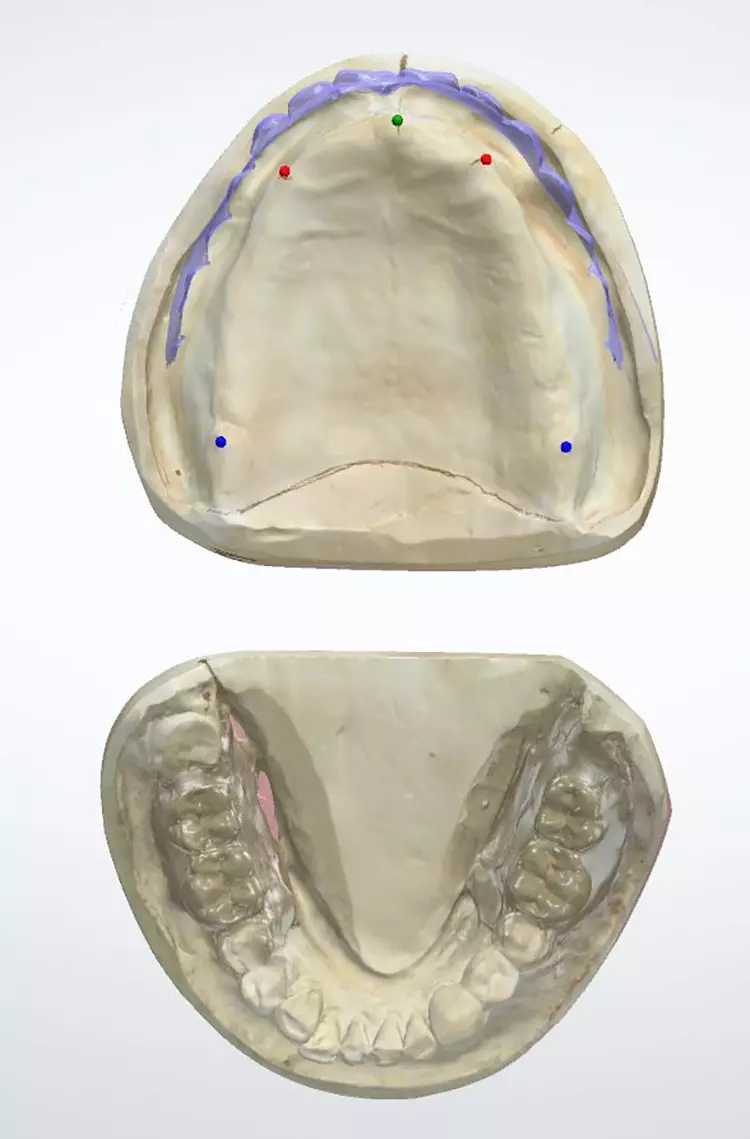Abb. 21: Die klassischen anatomischen Bezugspunkte werden auch digital genutzt, um die Aufstellung zu generieren (Papilla Inzisiva, Eckzahnpunkte und Tuber). Die lilafarbene Begrenzung stellt die alte Situation dar, die als Orientierung leicht eingeblendet wurde.