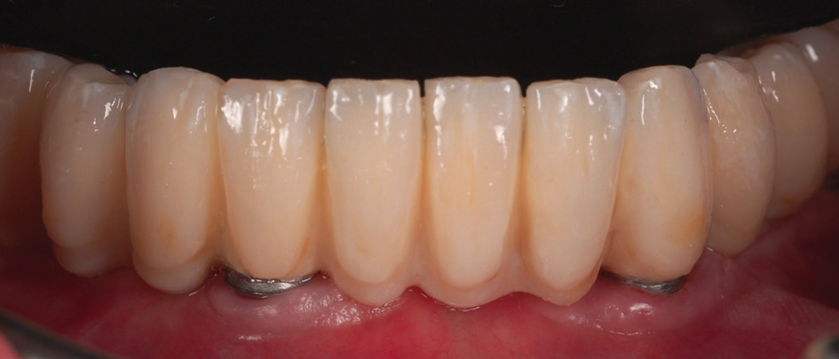 Abb. 21: Frontalansicht der implantatgetragenen Unterkieferbrücke.