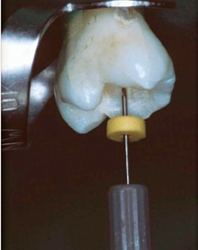 Abb. 11b: Erst nach Abtragen des Dentinüberhangs ist eine gradlinige Instrumentation möglich.
