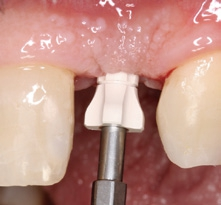 Abb. 21: Zwei Wochen nach der Freilegungs-OP mit Rolllappen wurde der Gingivaformer entfernt …
